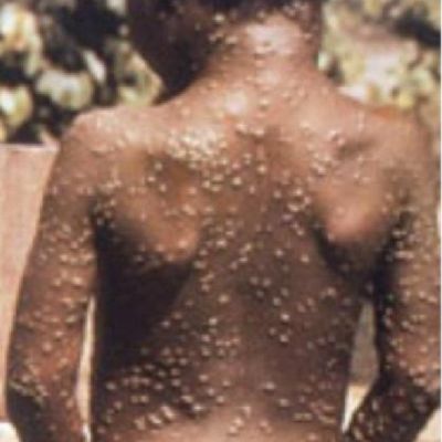 Clinical-picture-of-Monkeypox-rash-Image-credit-CDC-https-wwwcdcgov-poxvirus_Q640